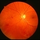 Radiation Retinopathy Radiation Retinopathy